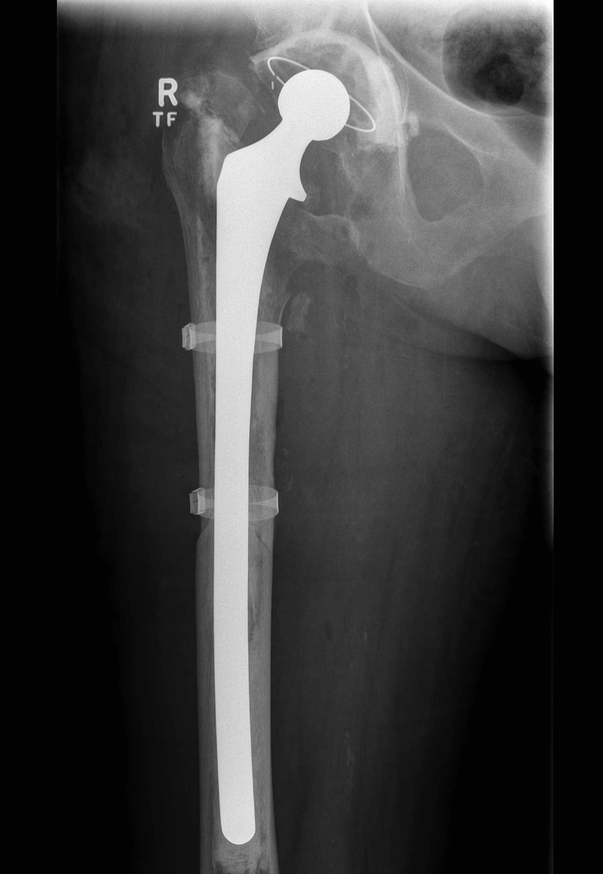THR Periprosthetic Fracture B1 Long stem cemented revision